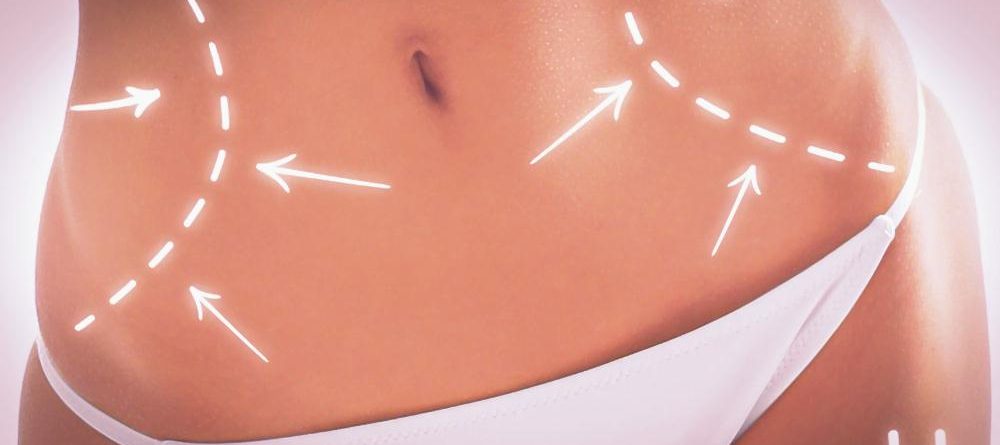 Karın germe ameliyatı (abdominoplasti) - Neo Estetik İstanbul Cerrahi Kliniği - NeoEstetik.com